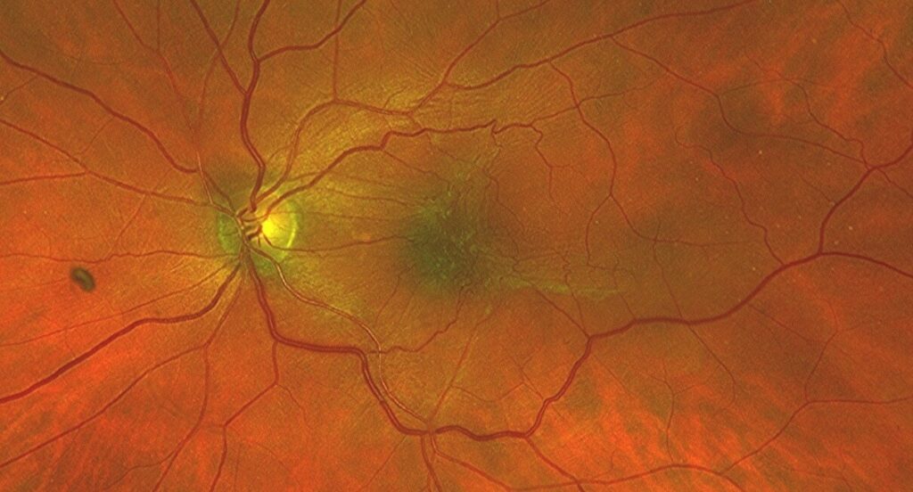 Fond d’œil montrant une membrane épimaculaire