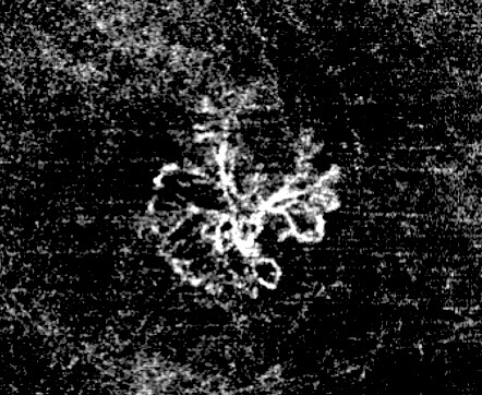 OCT-angiographie (OCTA) néovaisseaux choroïdiens DMLA exsudative humide