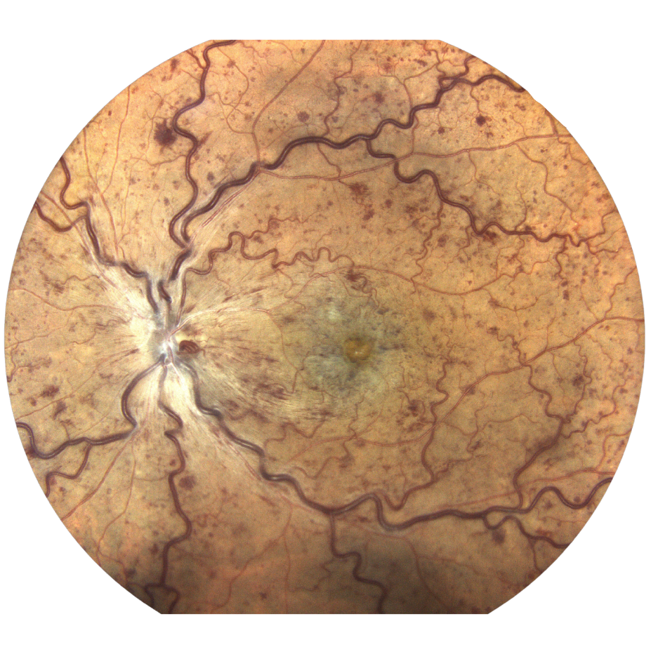 Fond d’œil montrant une occlusion veineuse rétinienne