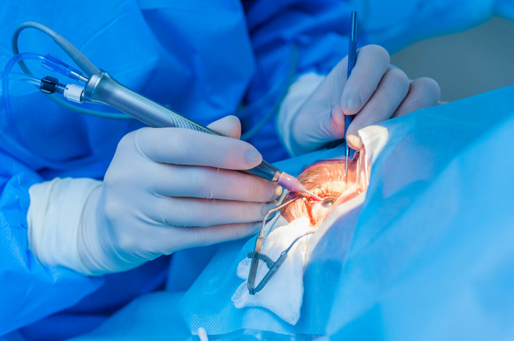 Intervention de chirurgie de la cataracte au Centre Rétine Mathilde