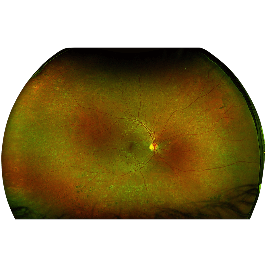 Fond d’œil avec laser de la rétine au Centre Rétine Mathilde photocoagulation rétinienne rétinopathie diabétique diabète