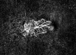 OCT angiographie néovaisseaux myopie forte